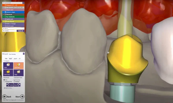 Custom Abutments - Image 3
